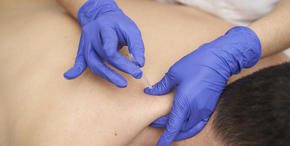 A practitioner wearing blue disposable gloves inserts an acupuncture needle into someone's upper back.