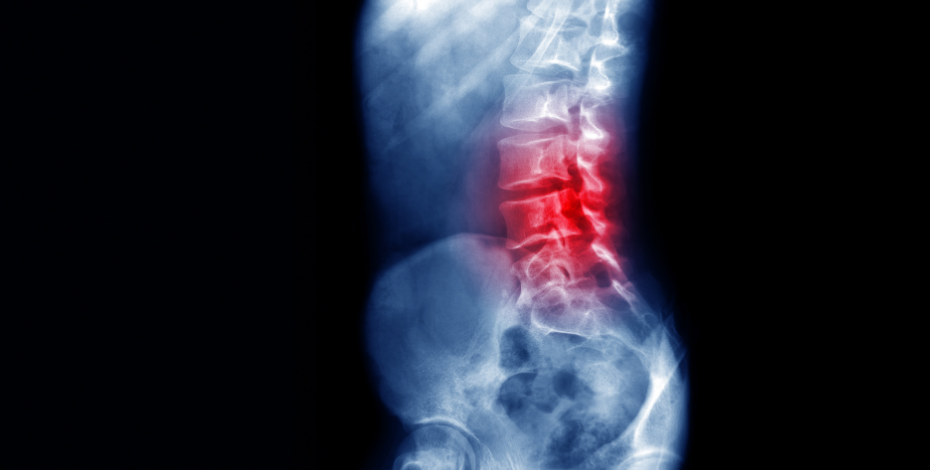 Picture of an x-ray with the lower spine highlighted in red