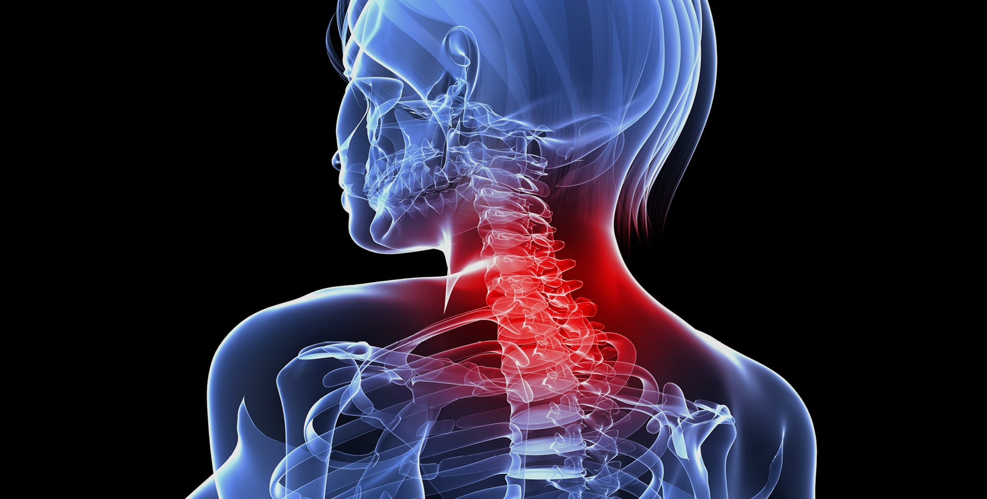 Physiotherapy management of neck pain