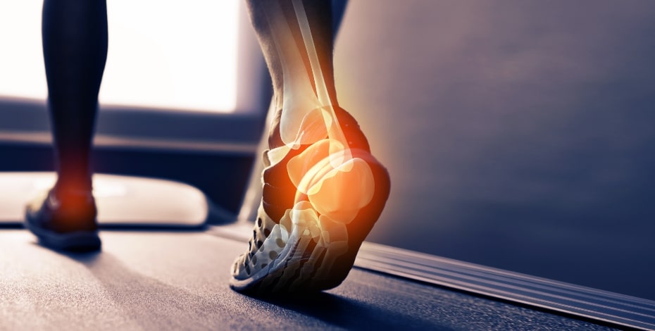 Artistic image of a foot walking away from the viewer, with an area of the heel in yellow to signal foot pain.