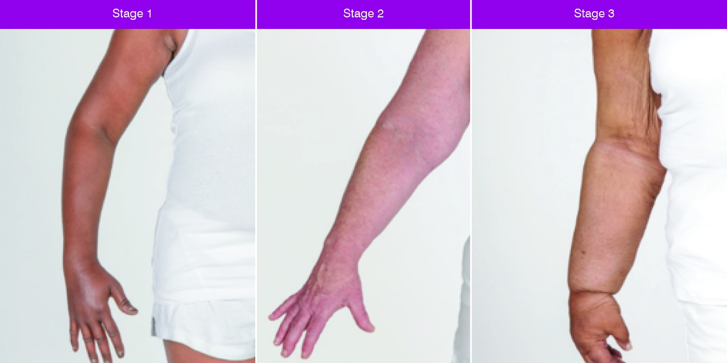 Three arms in various stages of lymphodema. 