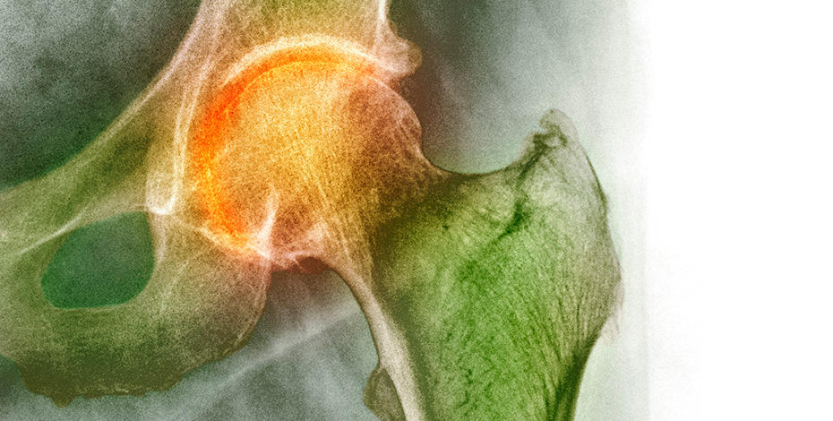 An illustration of a hip joint x-ray