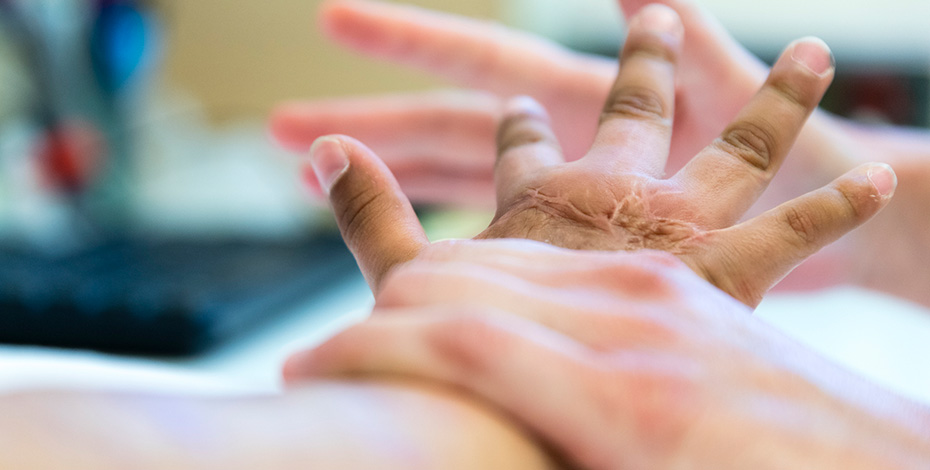 A therapist's hands hold the hands of a patient with burns and scarring.
