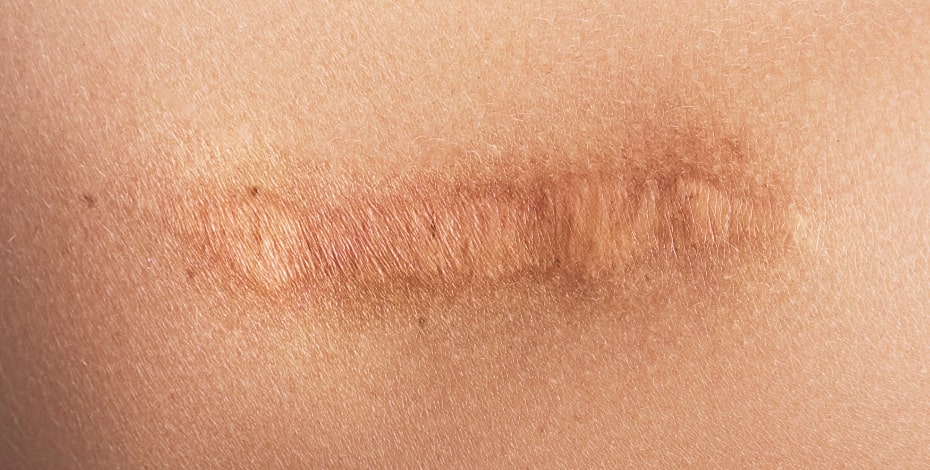 A strip of scar tissue on a person's body.