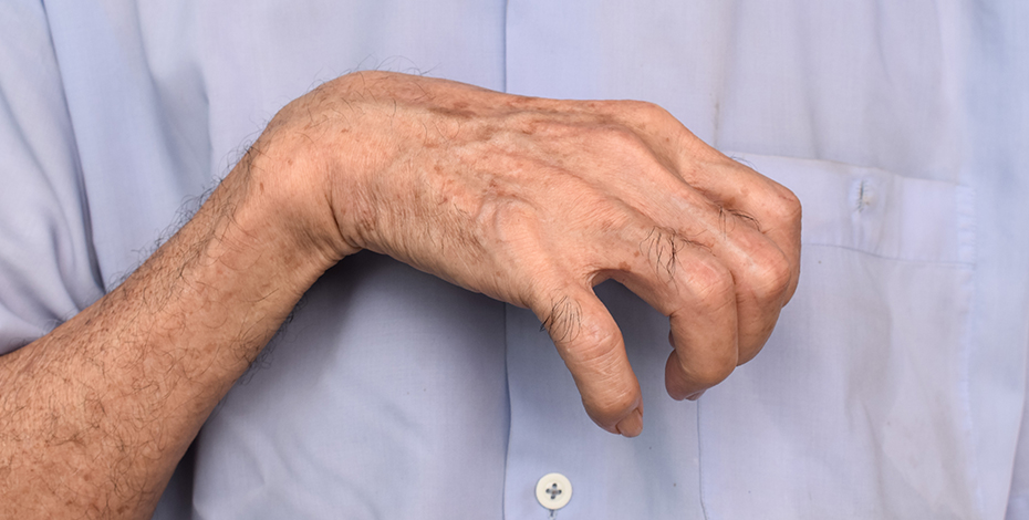 a picture of a person's hand affected by muscle spasticity 
