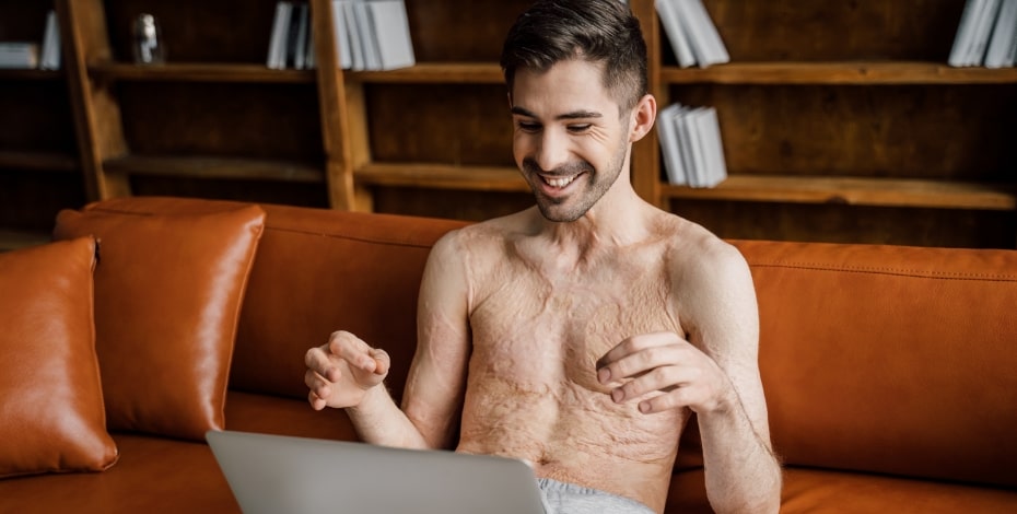person with scars looking happy at a laptop