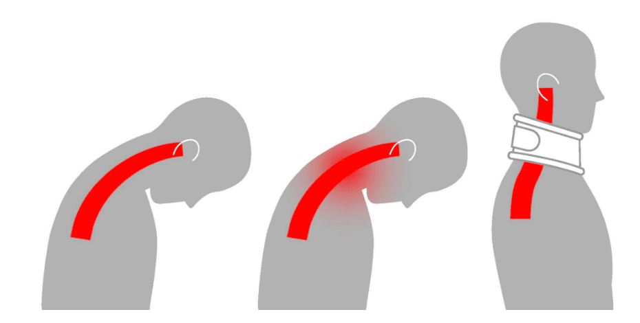 The image is an illustration of the spine during and after whiplash injury