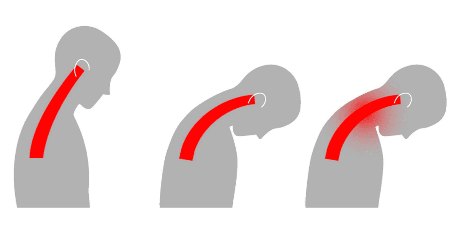 The image is an illustration of the spine during and after whiplash injury