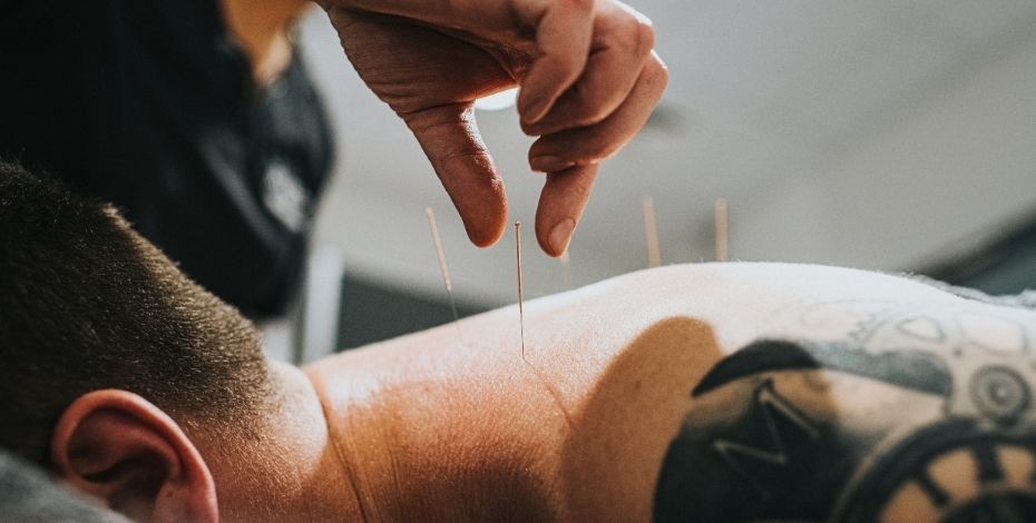 An image of acupuncture on a patient. 