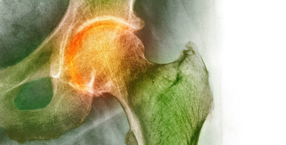 An x-ray of a hip joint