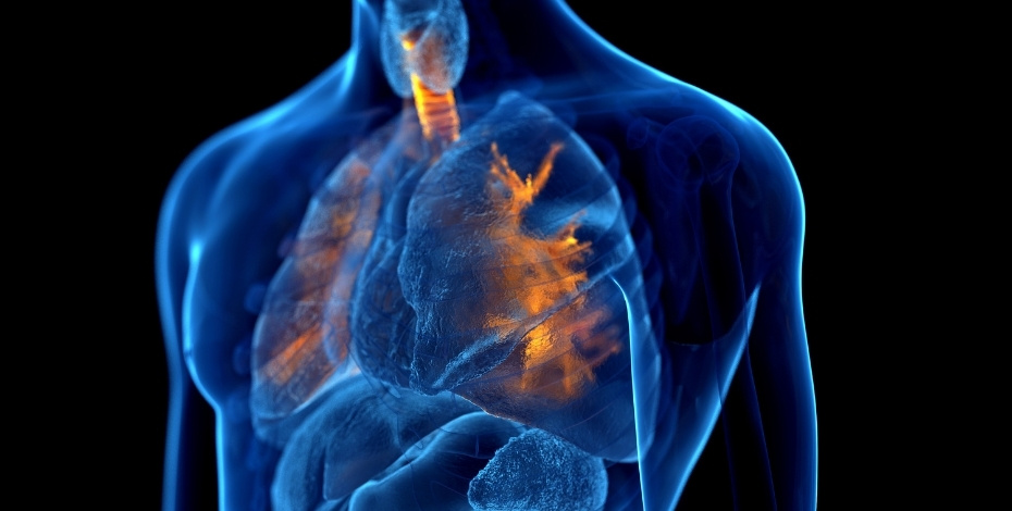 Graphic of the lungs with bronchiectasis