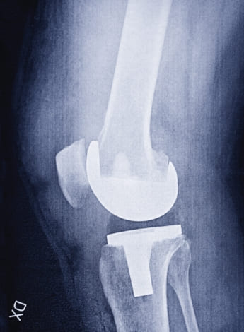 An x-ray image of an artificial knee joint.