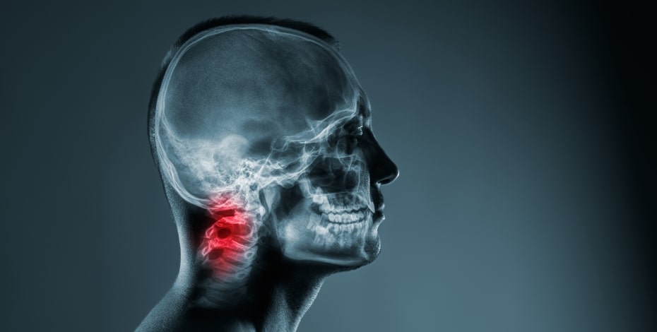 Cervical myelopathy on a background of chronic stroke