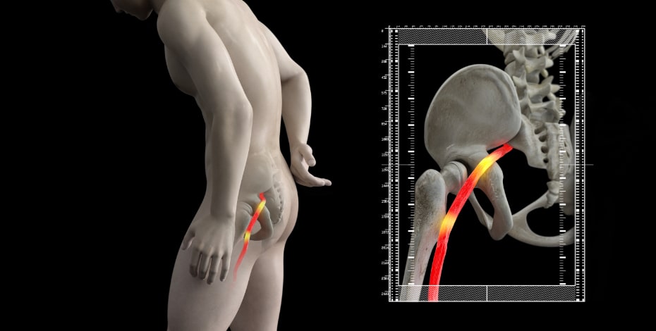 Physiotherapy management of sciatica
